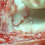 arthrose-im-kniegelenk-nach-unbehandeltem-kreuzbandriss