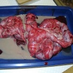 Gebaermuttervereiterung-geplatzter-uterus-150x150