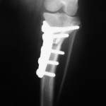 TPLO-2