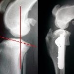 tibial-plateau-leveling-osteotomy