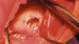 Die knöcherne Abdeckung der Paukenhoehle wird Stueckweise abgetragen. Die Paukenhoehle der Katze ist durch ein Septum (gelber Kreis) in eine große und eine kleine Kammer unterteilt.