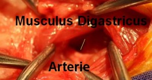 Der feine gelbe Strich markiert den hinteren Rand der Paukenhoehle, nachdem ein Muskel und Arterie freipäpariert und verlagert wurden.