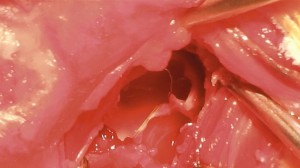 Nach Entnahme des Polypen ist der Hohlraum der kleinen Kammer der Paukenhoehle gut zu erkennen. Ohne die Eroeffnung der kleinen Kammer kann der Polyp nicht aufgefunden werden.