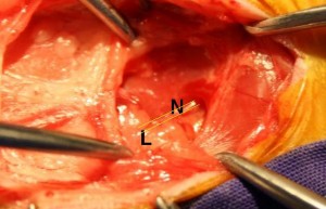 Nervus hyoglossus und Lymphknoten werden dargestellt und schonend aus dem Operationsbereich heraus verlagert.