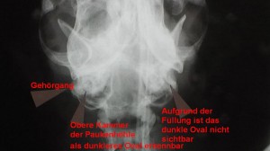 Entzündliche Ohrpolypen des knöchernen Gehörganges können durch Röntgenaufnahmen dargestellt werden.