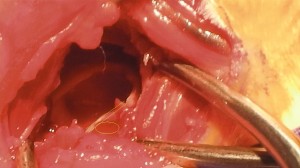 Gelb umkreist ist die Masse des Polypen in der kleineren Kammer erkennbar. Das Septum ist durch 2 parallele Linien markiert.